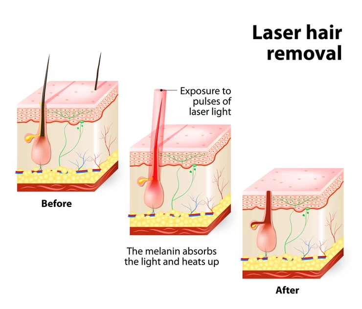 HOW DOES LASER HAIR REMOVAL WORK?