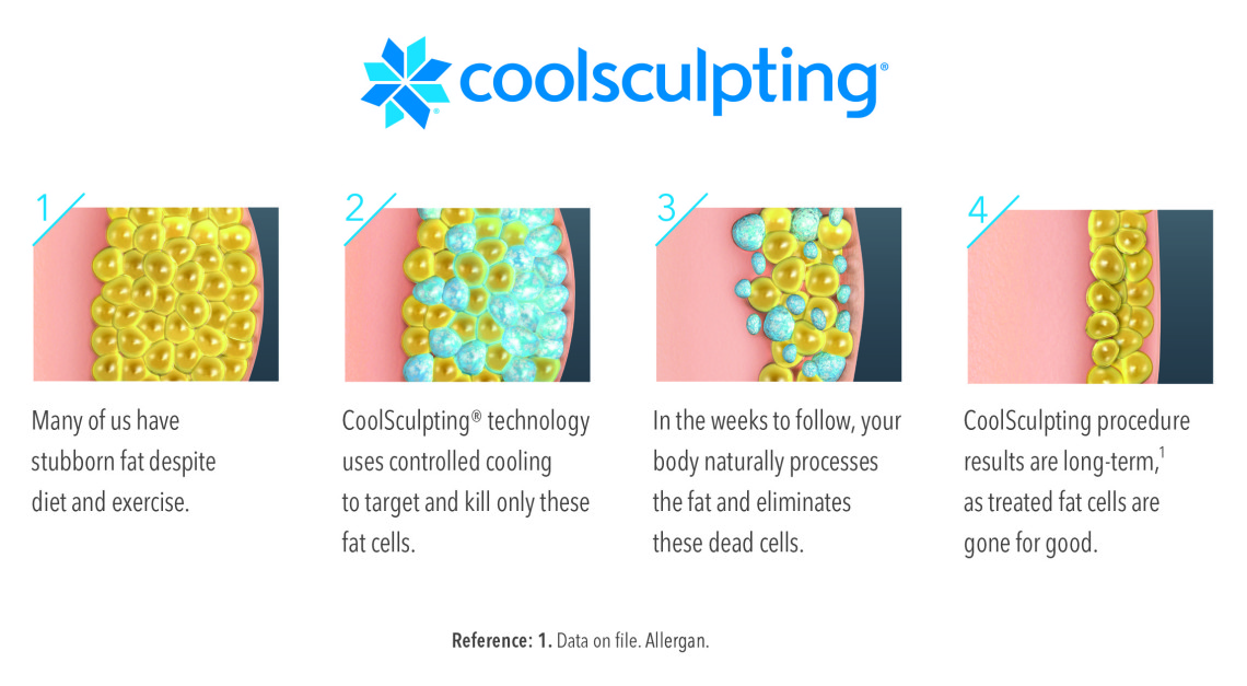 Tondue - Bye bye bra fat! CoolSculpting can help target those stubborn  areas of fat that are tough to target with workouts and diet. BONUS: we can  treat both sides of the