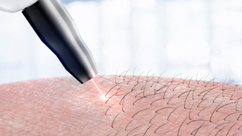 Laser Hair Removal