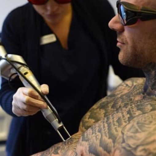 unwanted tattoo removal treatment