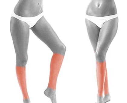 Women Lower Legs and Knees Laser Hair Removal in NYC