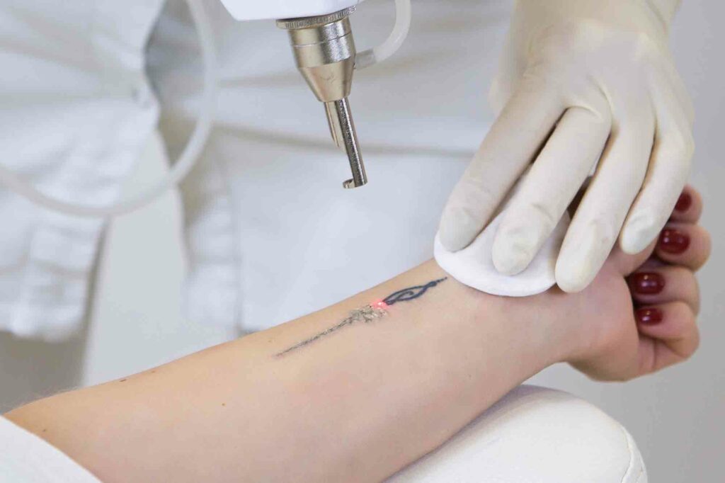 LASER TATTOO REMOVAL