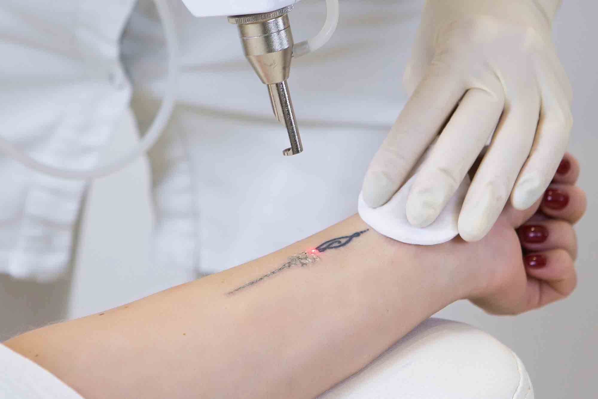 How Much Does Laser Tattoo Removal Cost?
