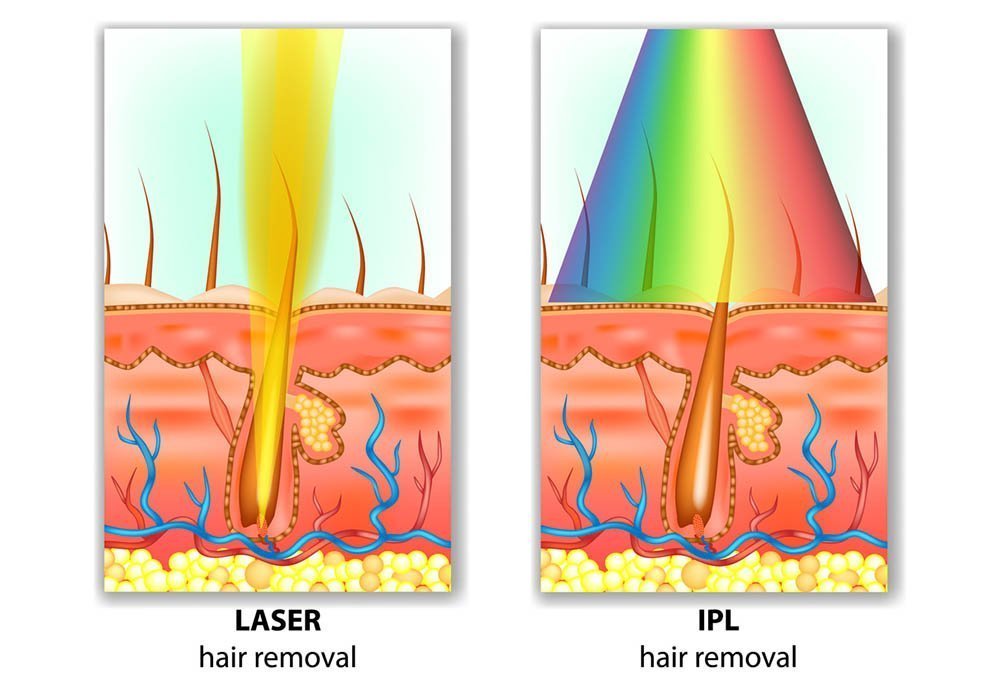 Laser Hair Removal vs. IPL Hair Removal: Which One is Best? - Laser Spa In  NYC