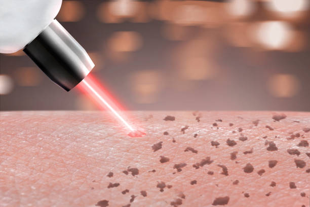 Common Misconceptions About Laser Pigmentation Removal