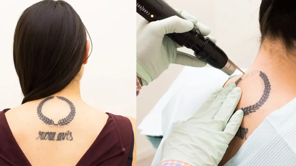 Laser Treatment Can Remove Tattoos