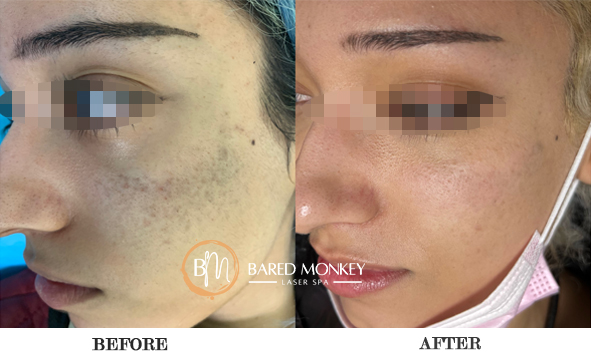 before and after-2 MASK