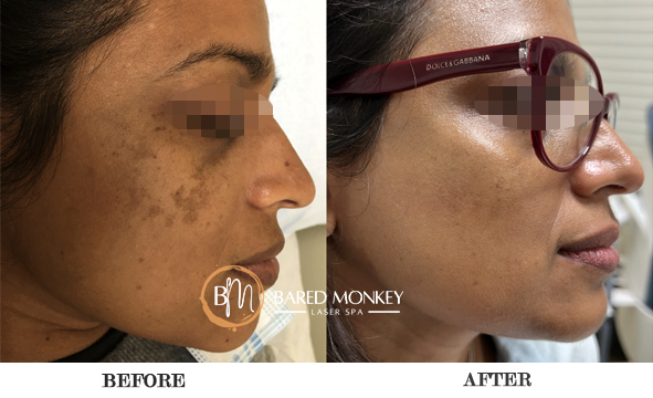 before and after-skin 1-MASK