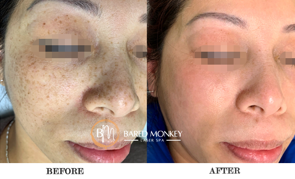 before and after-skin 3-MASK