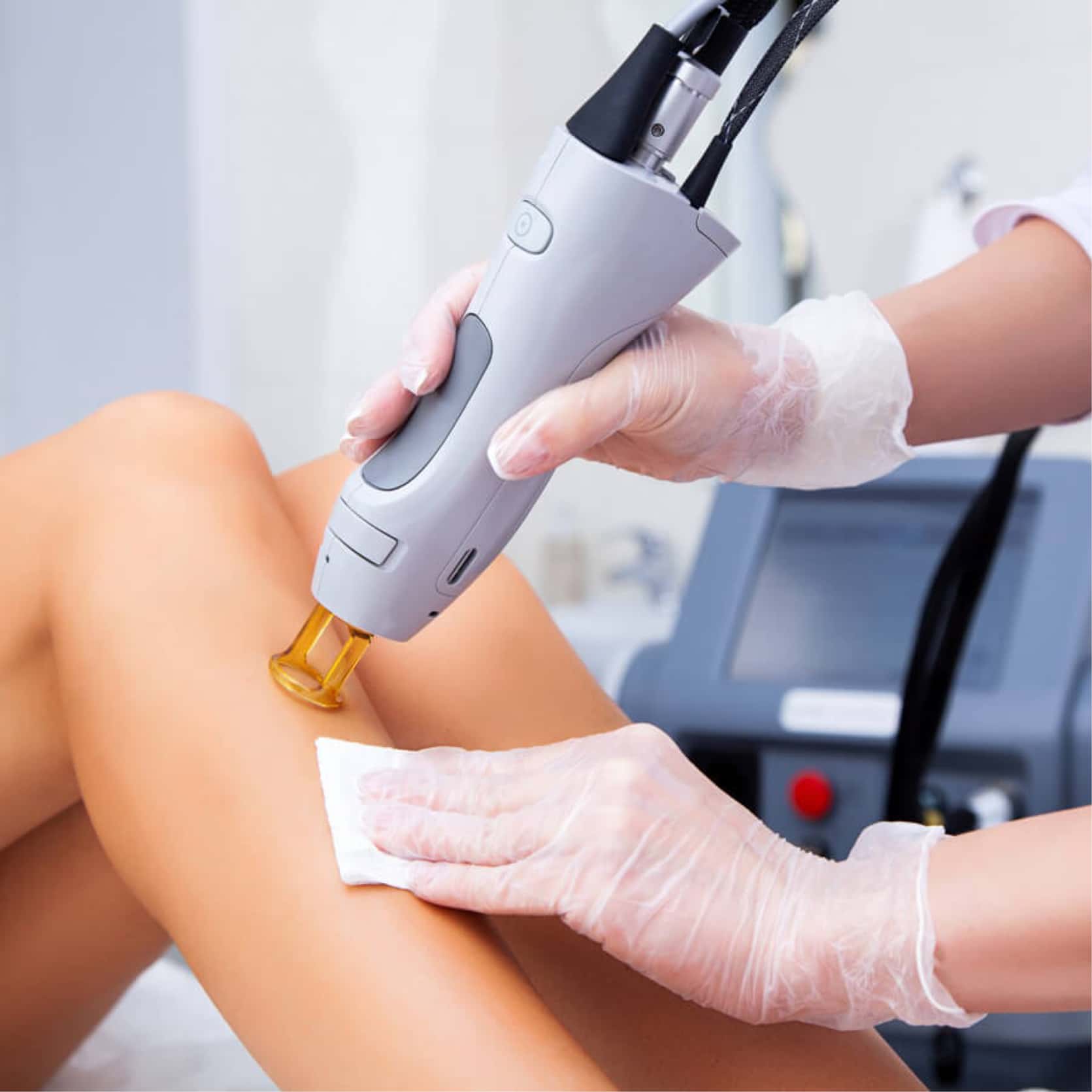 laser hair removal