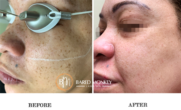before and after-skin 4-MASK