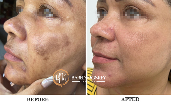 before and after-skin tx-5