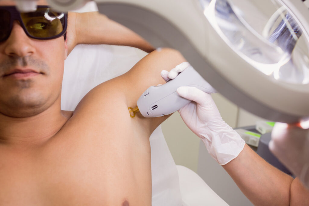 laser hair removal for men