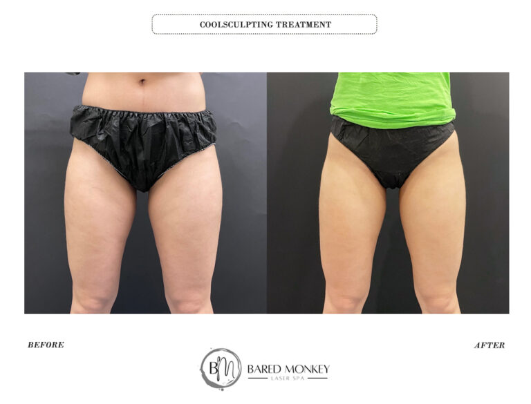 COOLSCULPTING BEFORE AND AFTER