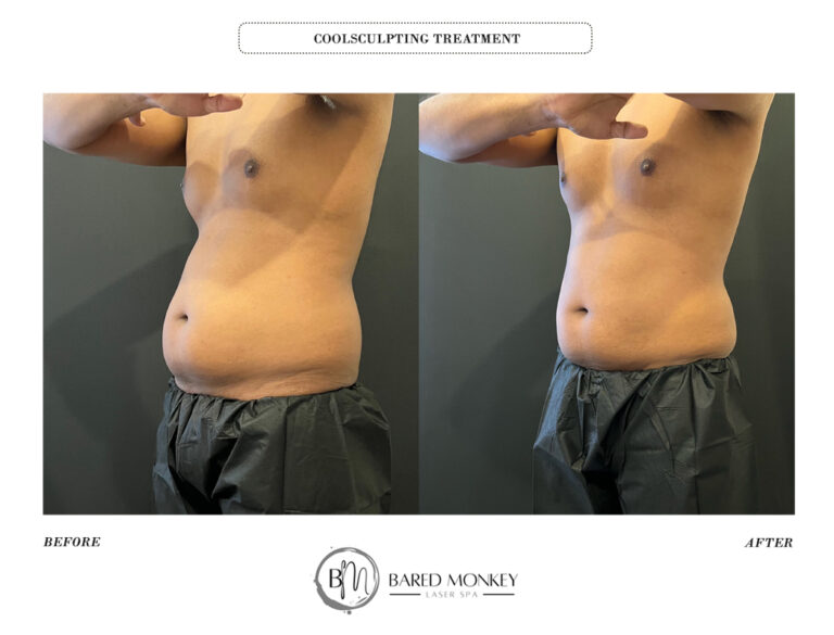 COOLSCULPTING BEFORE AND AFTER