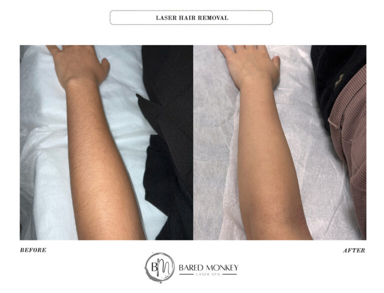LASER HAIR REMOVAL BEFORE AND AFTER