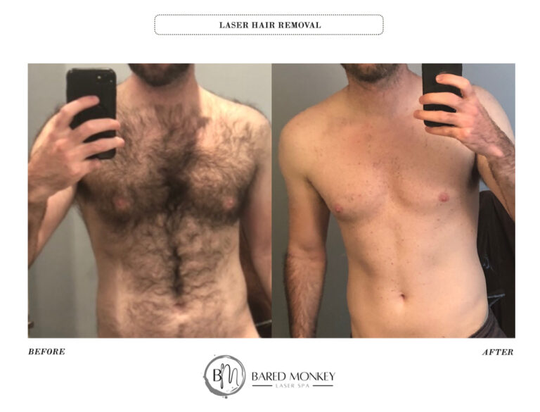 LASER HAIR REMOVAL BEFORE AND AFTER