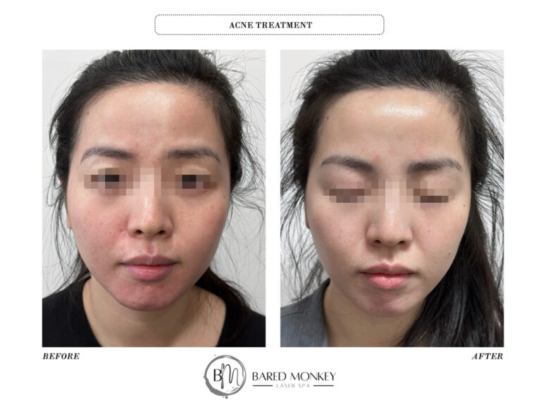 skin treatment-before and after
