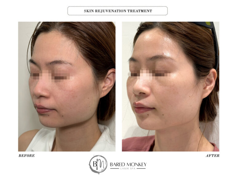 skin treatment-before and after
