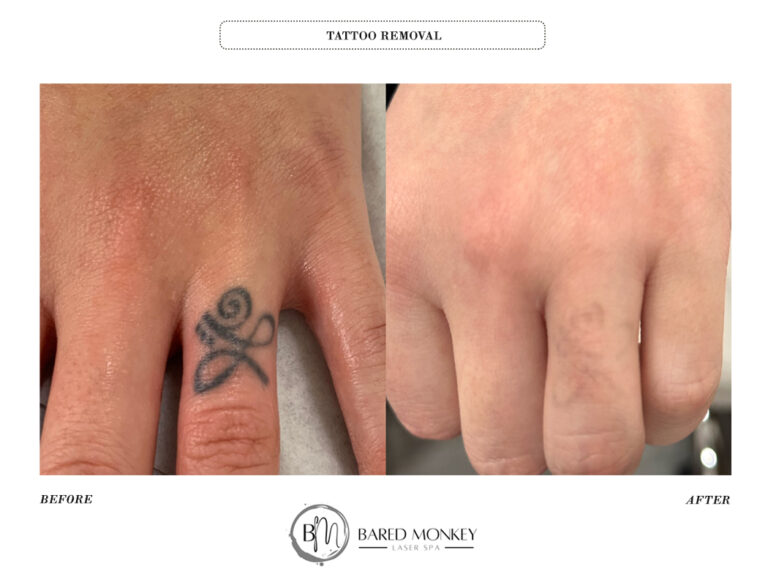 Before  After Results  Austin Tattoo Removal  Clean Slate Ink