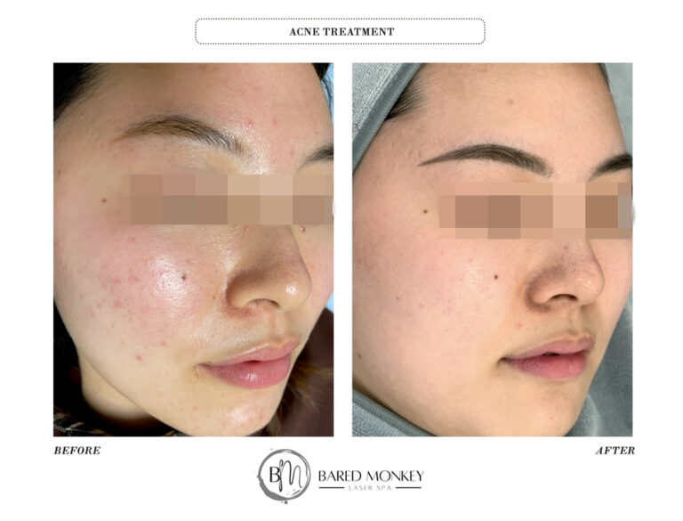 skin treatment before and after