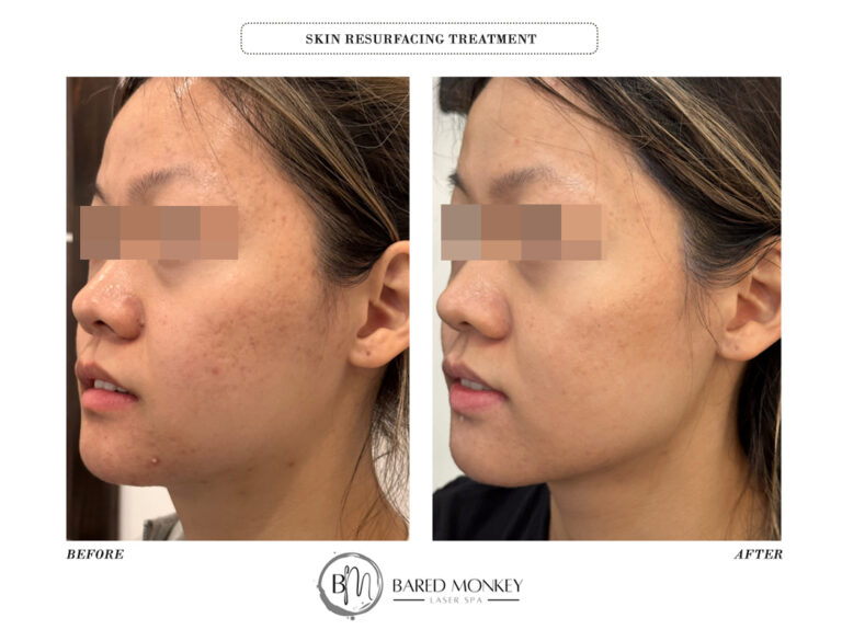 skin treatment before and after
