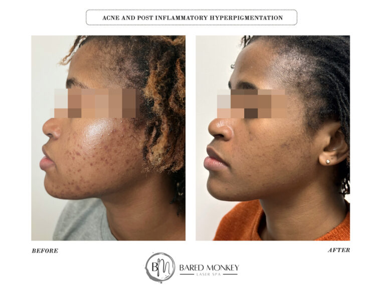 Acne & Post inflammatory hyperpigmentation-1