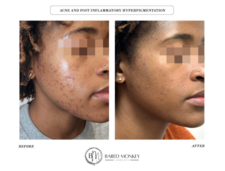 Acne & Post inflammatory hyperpigmentation-2