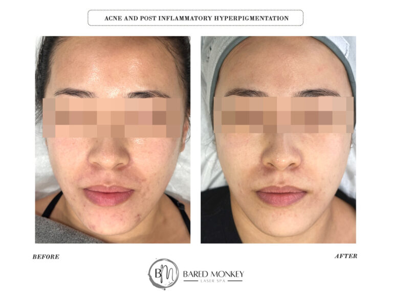 Acne & Post inflammatory hyperpigmentation-3