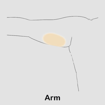 coolsculpting arm updated