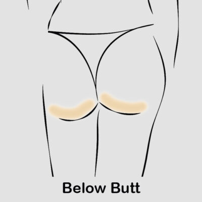 coolsculpting below butt updated