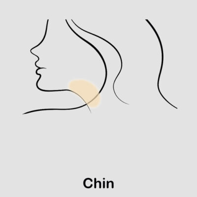 coolsculpting chin updated