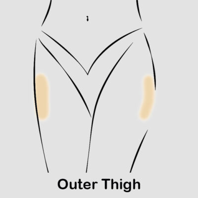 coolsculpting outer thigh updated